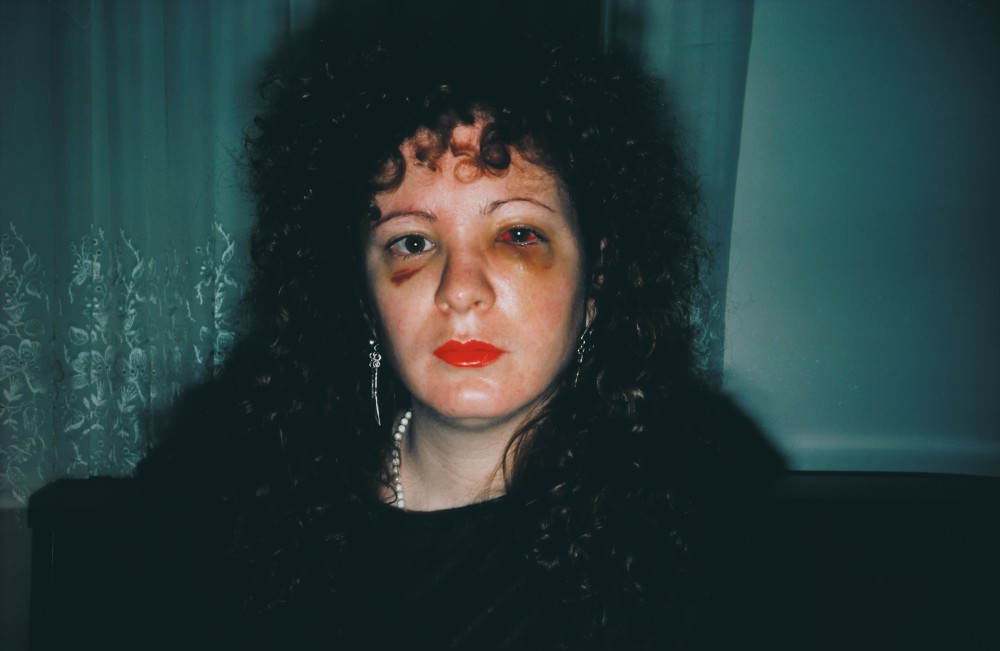 Nan Goldin - Nan one month after being battered, 1984<small>© Westlicht / Nan Goldin</small>